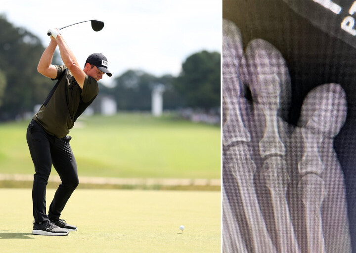 Bildet på Instagram etterlot liten tvil: Viktor Hovland har brukket en tå.